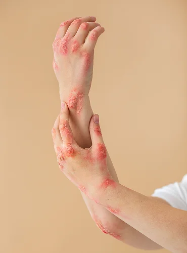 Burn Injuries